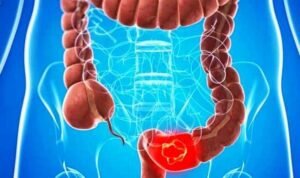 Mengenali Bisikan Usus: Panduan Lengkap Gejala Kanker Usus