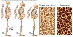 Osteoporosis: Ketika Tulang Menjadi Rapuh, Mencegah Lebih Baik daripada Mengobati
