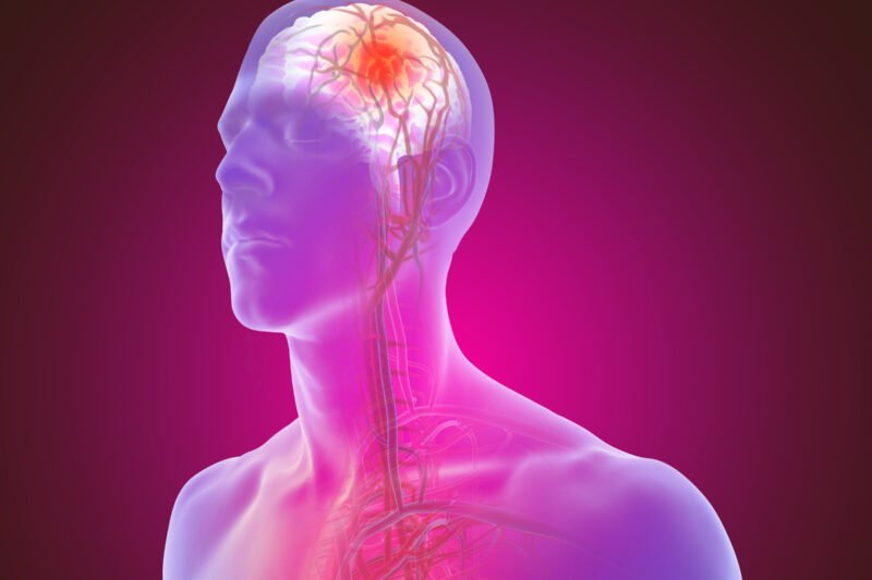 Stroke di Usia Muda: Ancaman yang Semakin Nyata dan Cara Menghadapinya